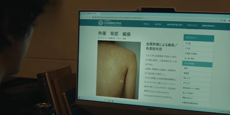 真に「金属熱傷」の画像を見せる稔